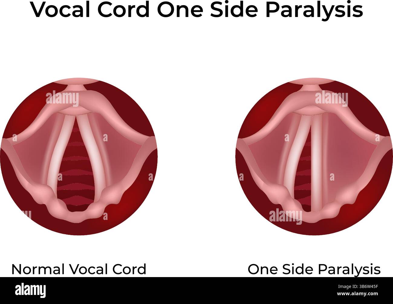 Paralysie des cordes vocales illustration vectorielle One Side Design Illustration de Vecteur