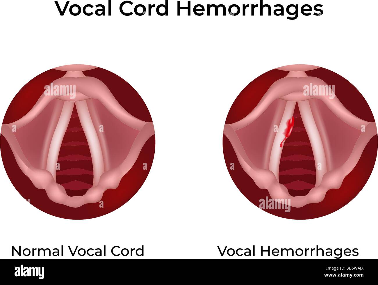 Illustration vectorielle de conception d'hémorragie de corde vocale Illustration de Vecteur