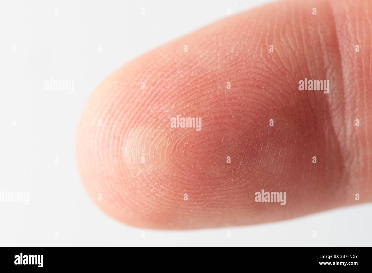 Peau de doigt blessée avec cloques macro vue en gros plan Banque D'Images