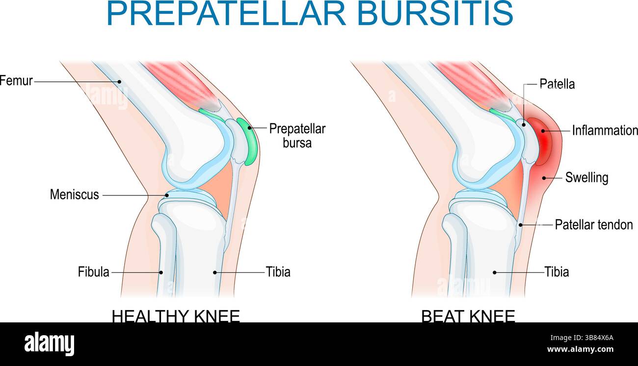 Bursite prépatellaire. Inflammation de l'articulation du genou. Illustration vectorielle. Affiche médicale. Schéma de principe Illustration de Vecteur
