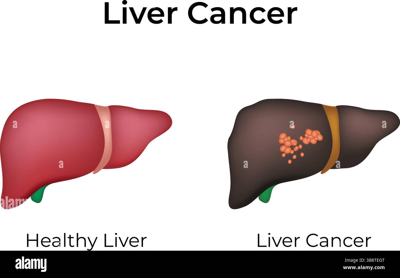 Cancer du foie vs illustration vectorielle de conception de foie sain Illustration de Vecteur