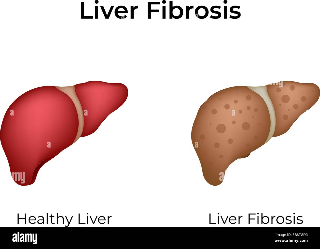 Fibrose hépatique saine vs malade illustration vectorielle de conception de foie Illustration de Vecteur