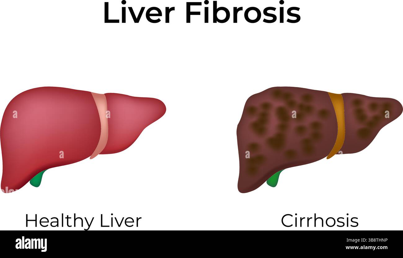 Fibrose hépatique saine vs malade illustration vectorielle de conception de foie Illustration de Vecteur