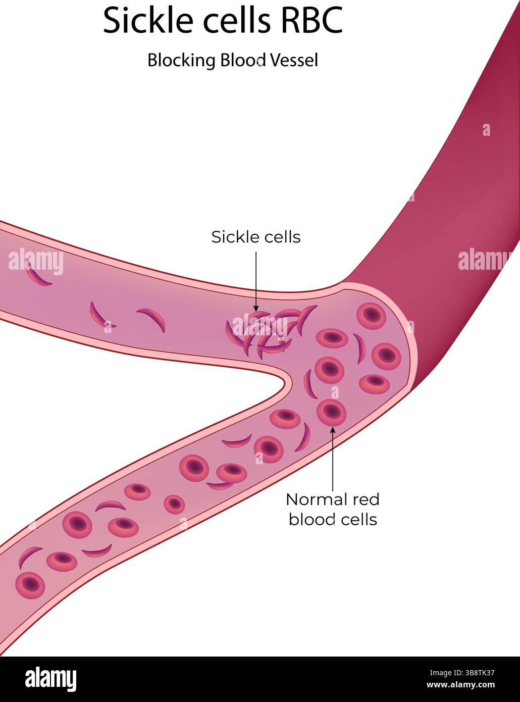 Drépanocytose bloquant un vaisseau sanguin illustration vectorielle Illustration de Vecteur