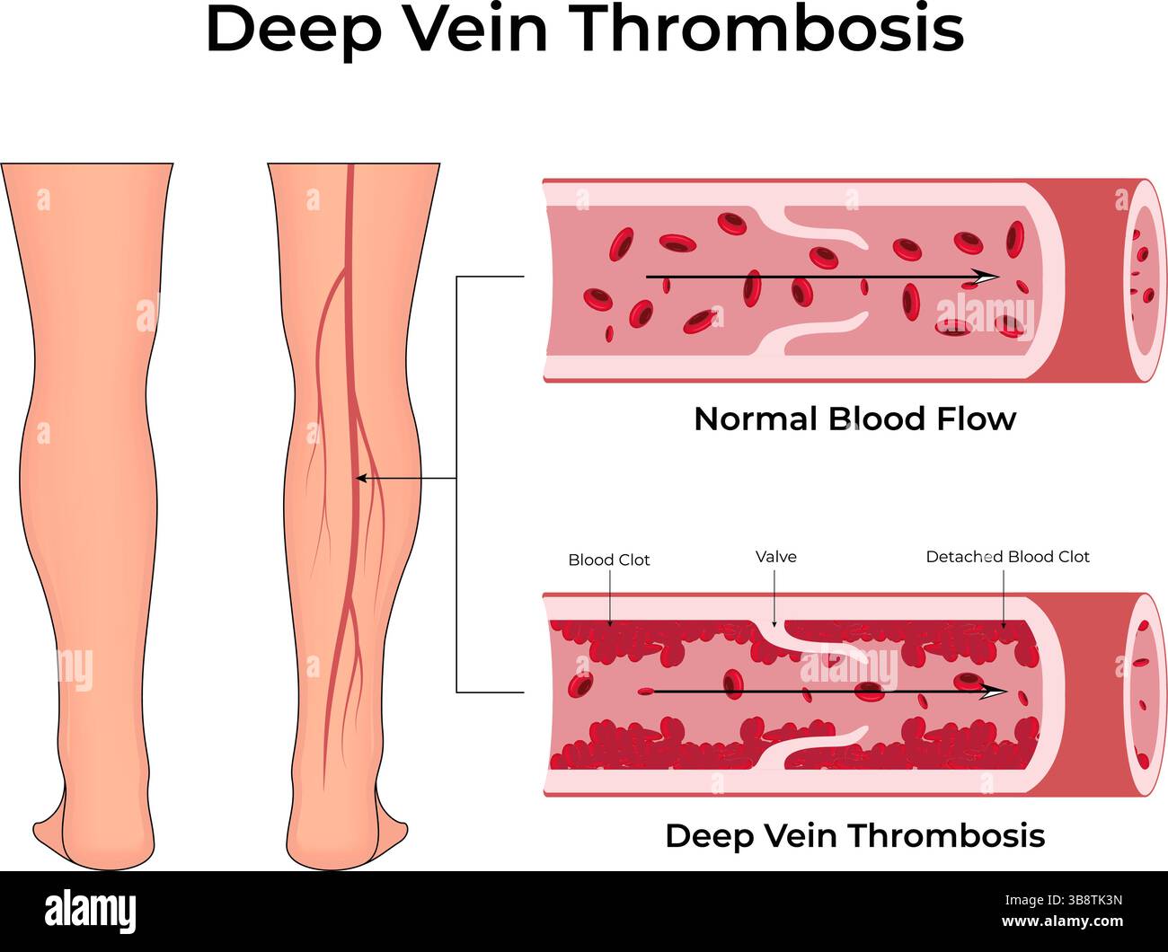 Thrombose veineuse profonde comprendre les caillots sanguins dans les veines illustration vectorielle Illustration de Vecteur