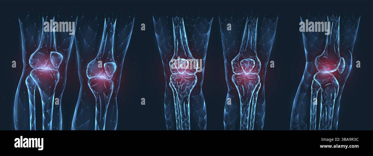 Douleur, blessure ou inflammation dans les genoux illustration vectorielle polygonale. Modèle poly bas des articulations douloureuses du genou Banque D'Images