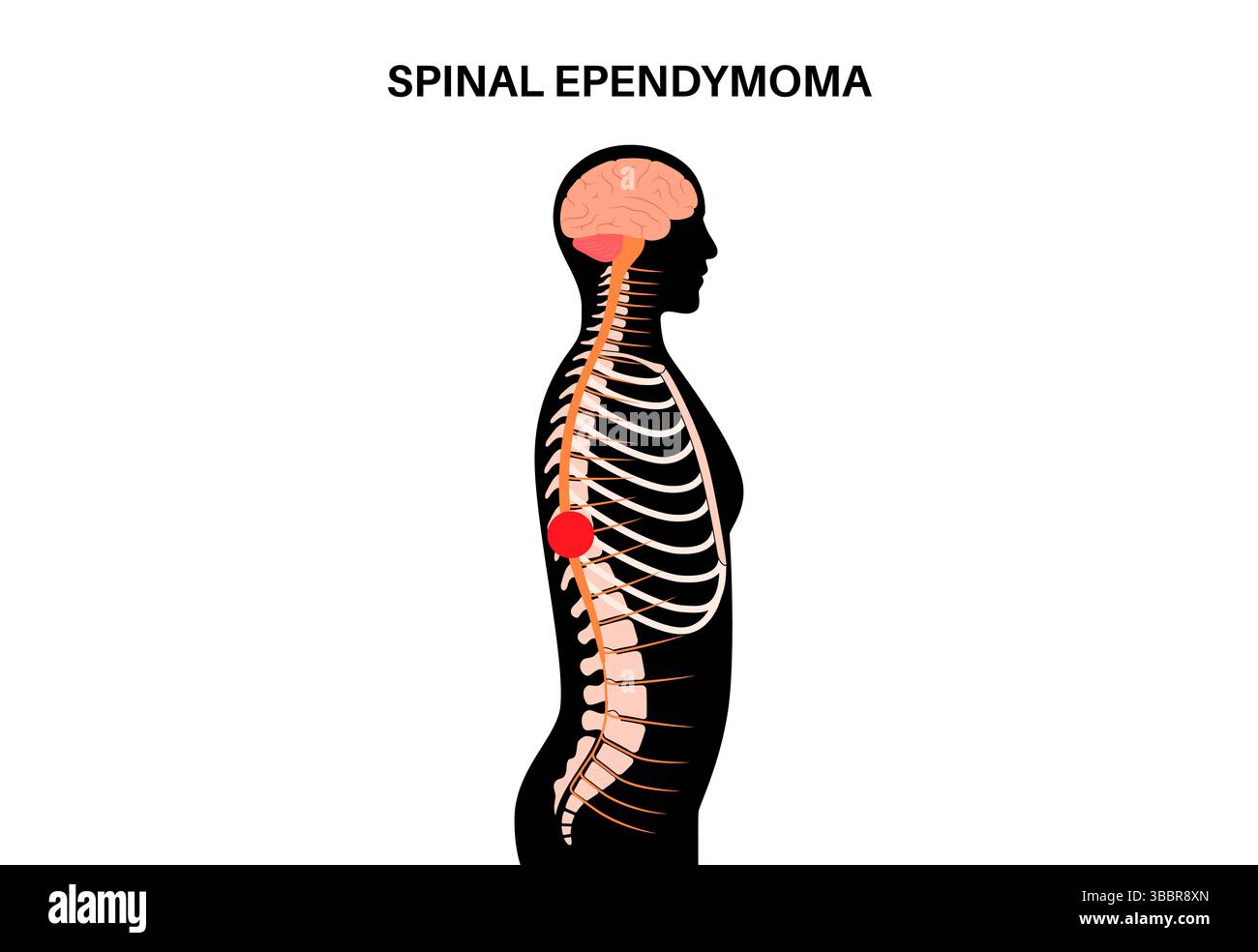Illustration d'un épendymome rachidien. C'est une tumeur qui se développe dans la moelle épinière. Elle provient des cellules épendymales qui tapissent le canal central de la moelle épinière. Ces tumeurs sont généralement à croissance lente et peuvent comprimer la moelle épinière, entraînant des symptômes comme un engourdissement, une faiblesse ou une douleur. Banque D'Images