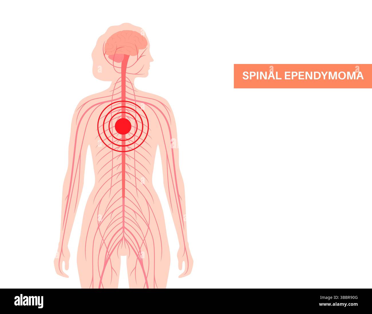 Illustration d'un épendymome rachidien. C'est une tumeur qui se développe dans la moelle épinière. Elle provient des cellules épendymales qui tapissent le canal central de la moelle épinière. Ces tumeurs sont généralement à croissance lente et peuvent comprimer la moelle épinière, entraînant des symptômes comme un engourdissement, une faiblesse ou une douleur. Banque D'Images