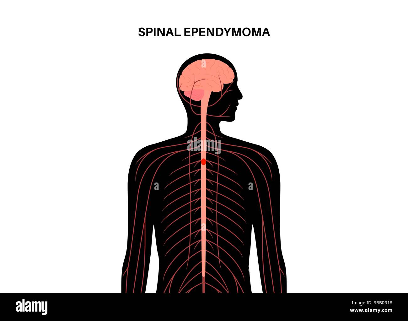 Illustration d'un épendymome rachidien. C'est une tumeur qui se développe dans la moelle épinière. Elle provient des cellules épendymales qui tapissent le canal central de la moelle épinière. Ces tumeurs sont généralement à croissance lente et peuvent comprimer la moelle épinière, entraînant des symptômes comme un engourdissement, une faiblesse ou une douleur. Banque D'Images