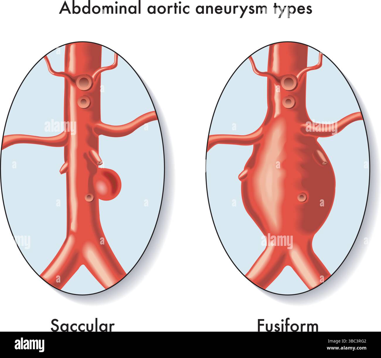 Illustration médicale de types d'anévrismes de l'aorte abdominale, avec annotations Illustration de Vecteur