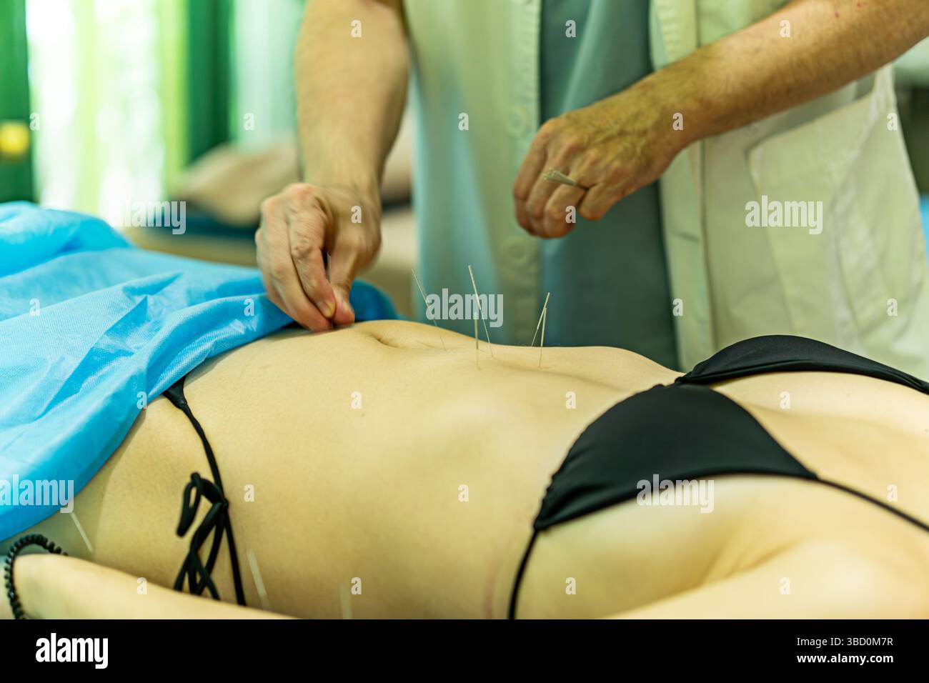 Traitement d'acupuncture à aiguille sèche. Thérapie Spa médicale féminine Banque D'Images