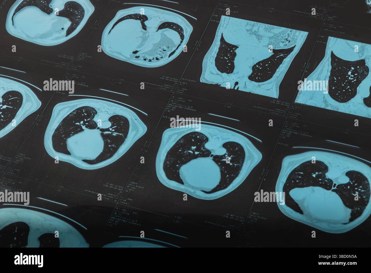 Les examens détaillés du thorax révèlent les structures internes, mettant en évidence les poumons et le cœur dans différentes coupes transversales. Les images fournissent un aperçu des condi pulmonaires Banque D'Images