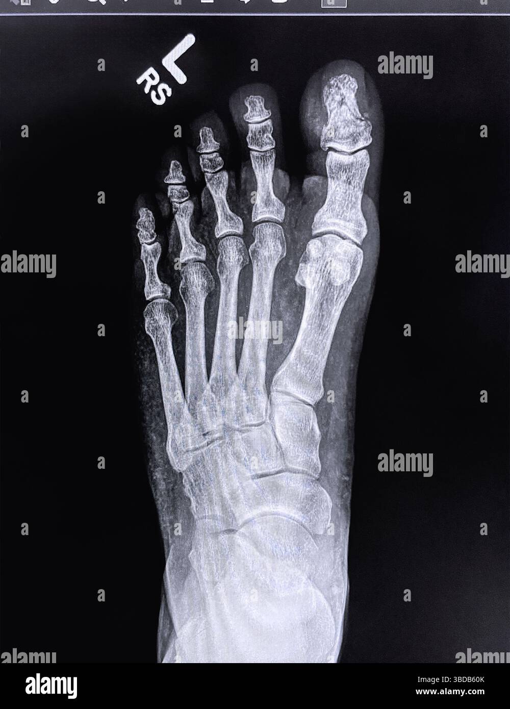 Radiographie de l'orteil cassé du pied gauche Banque D'Images