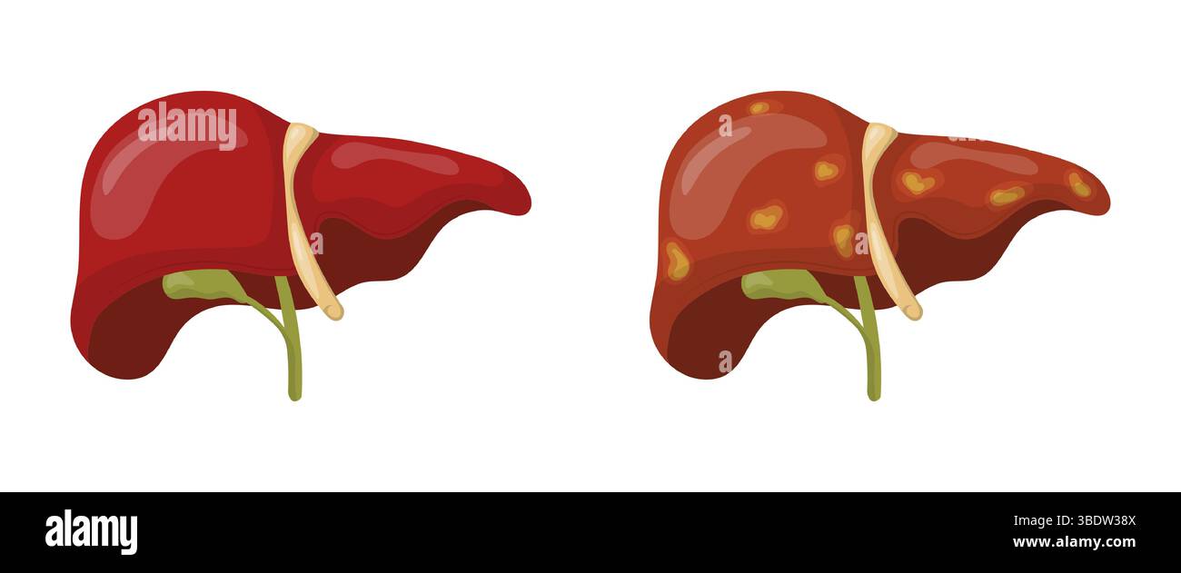 Illustration médicale comparant un foie sain à un foie malade, montrant la différence entre un organe normal et un organe atteint de cirrhose ou F. Illustration de Vecteur
