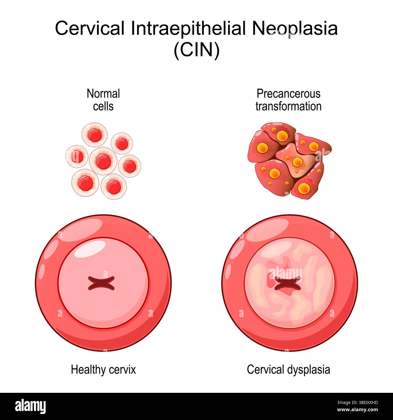 Néoplasie intra-épithéliale cervicale. Dysplasie cervicale. CIN. Procédé de développement du cancer de cellules normales à transformation précancéreuse de cellules Illustration de Vecteur Néoplasie intra-épithéliale cervicale. Dysplasie cervicale. CIN. Procédé de développement du cancer de cellules normales à transformation précancéreuse de cellules Illustration de Vecteur
