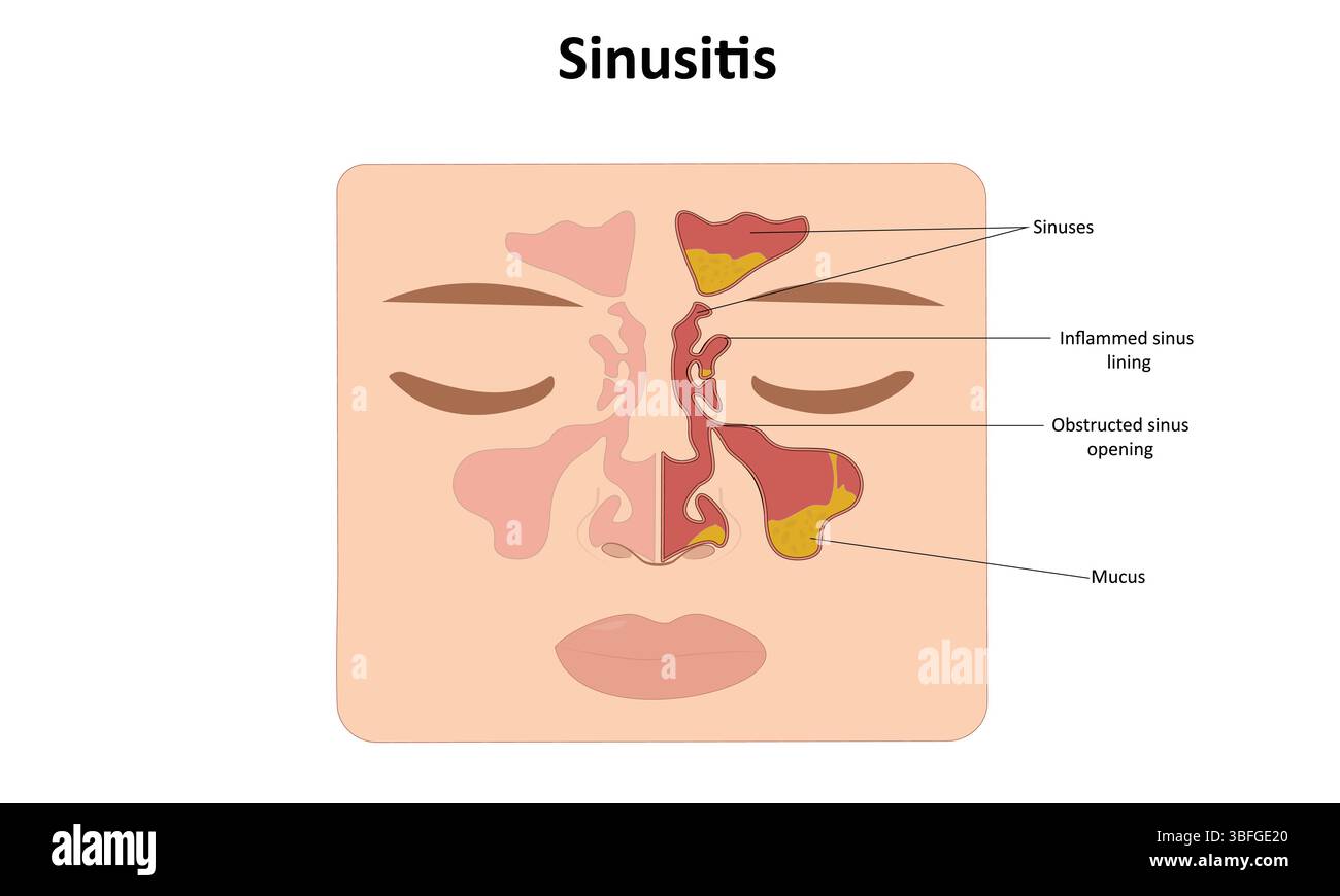 Illustration vectorielle de sinusite Illustration de Vecteur