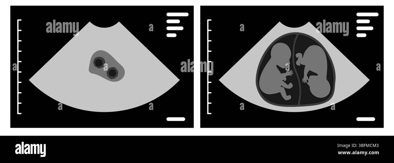 Moniteur à ultrasons affichant deux sacs amniotiques distincts, chacun contenant des jumeaux dizygotiques, mettant en évidence la complexité des grossesses multiples et pré Illustration de Vecteur