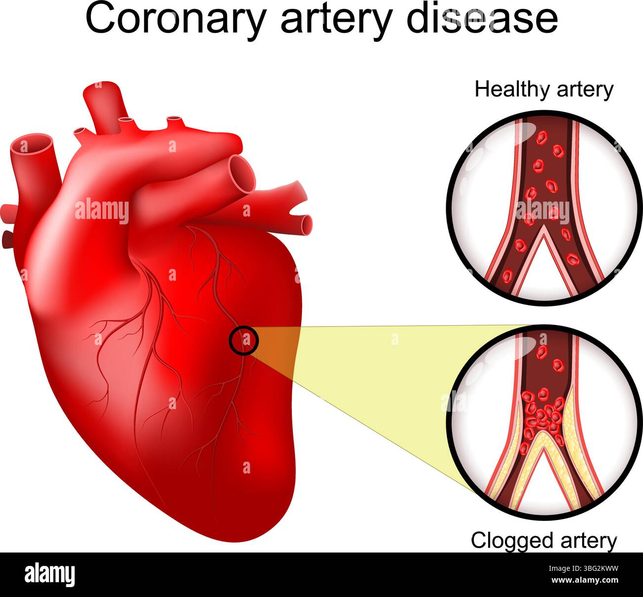 Coronaropathie. Cœur humain réaliste. Gros plan d'une artère saine et d'une coupe transversale d'une artère obstruée. Athérosclérose. Ischémie myocardique. Illustration de Vecteur