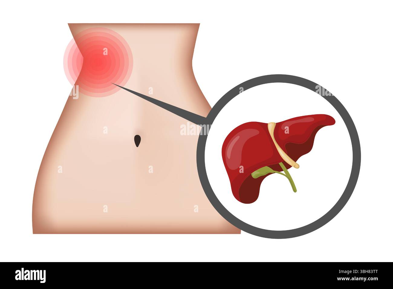Douleur hépatique montrant la zone douloureuse sur le corps féminin avec la zone rouge en surbrillance et vue rapprochée du foie indiquant des problèmes potentiels de foie, des problèmes de santé Illustration de Vecteur