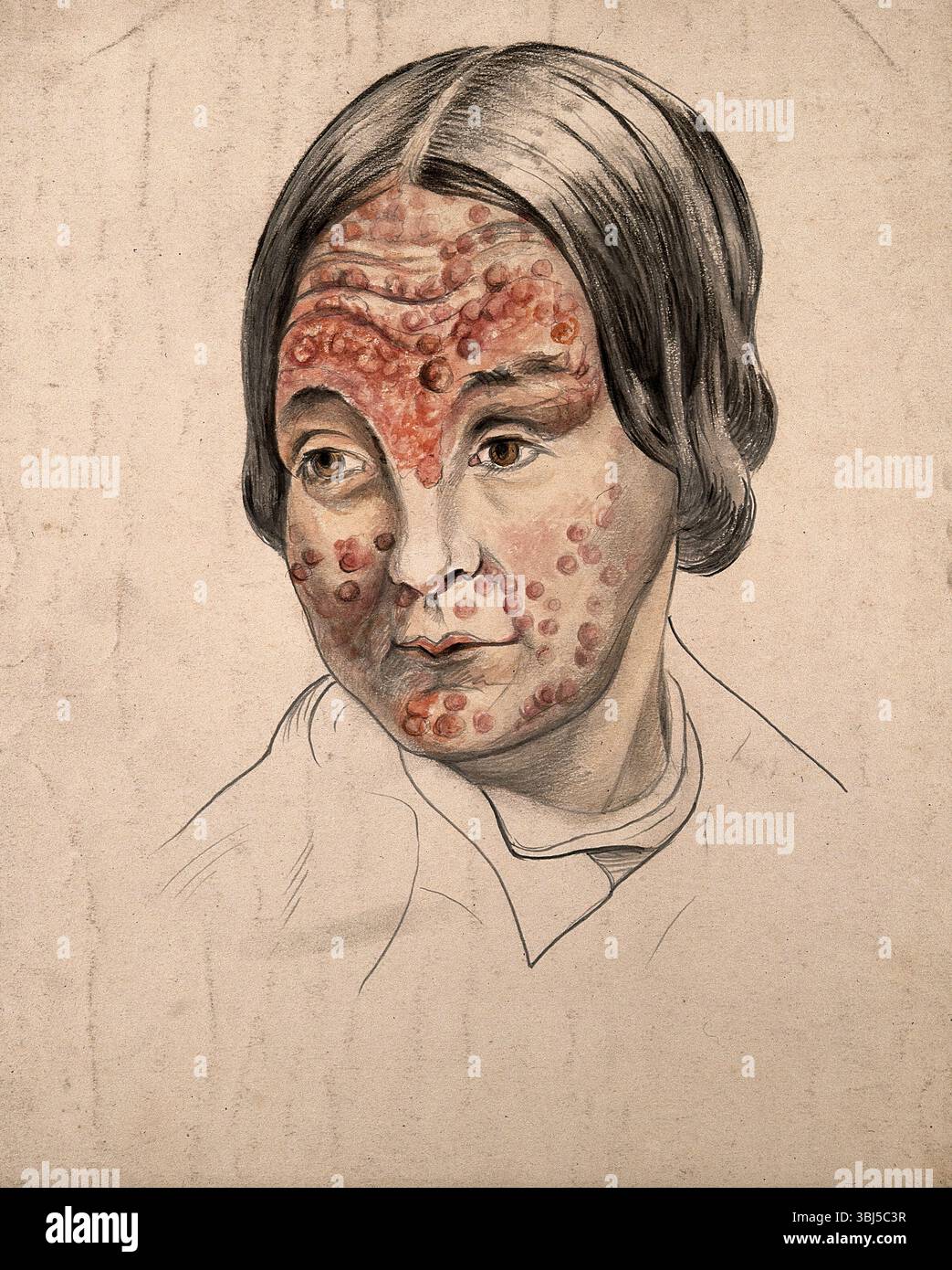 Tête d'une femme atteinte d'une maladie grave affectant son visage, (18)58. Banque D'Images Tête d'une femme atteinte d'une maladie grave affectant son visage, (18)58. Banque D'Images