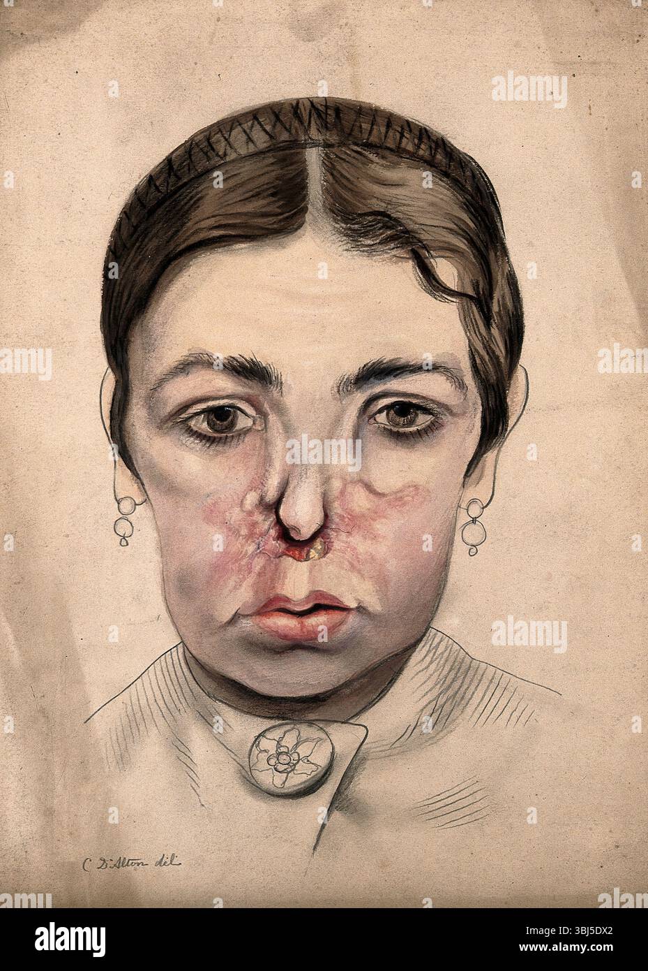 Tête d'une fille atteinte d'une maladie grave affectant son nez, 1869. Banque D'Images Tête d'une fille atteinte d'une maladie grave affectant son nez, 1869. Banque D'Images