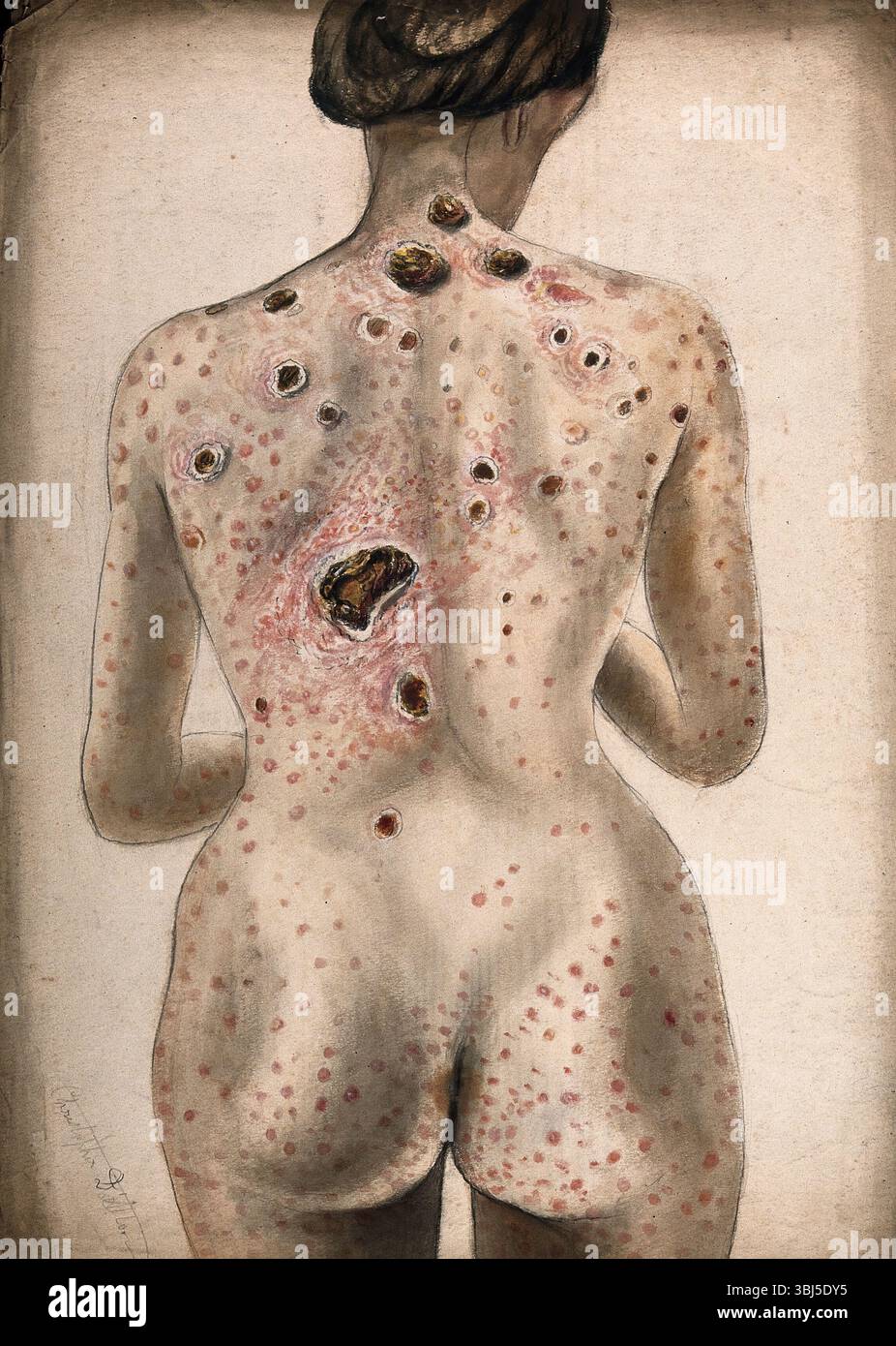 Le dos, les fesses et les bras d'une femme, montrant des zones de tissus malades et une éruption cutanée de plaies, (1840/1870 ?). Banque D'Images Le dos, les fesses et les bras d'une femme, montrant des zones de tissus malades et une éruption cutanée de plaies, (1840/1870 ?). Banque D'Images