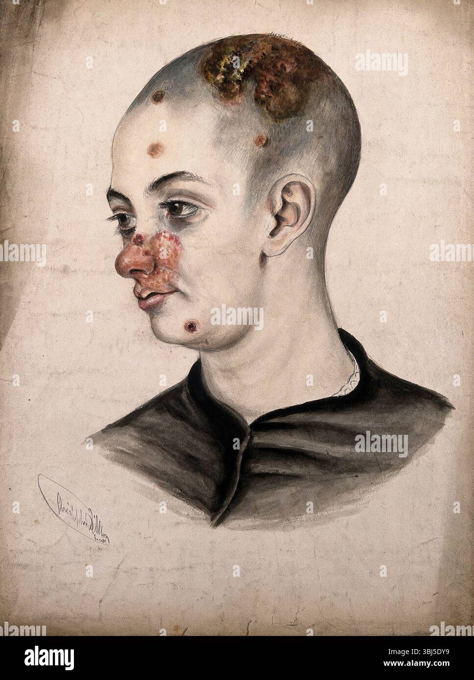 Tête d’une jeune femme atteinte d’une maladie grave touchant le visage et le cuir chevelu, (18)58. Banque D'Images Tête d’une jeune femme atteinte d’une maladie grave touchant le visage et le cuir chevelu, (18)58. Banque D'Images