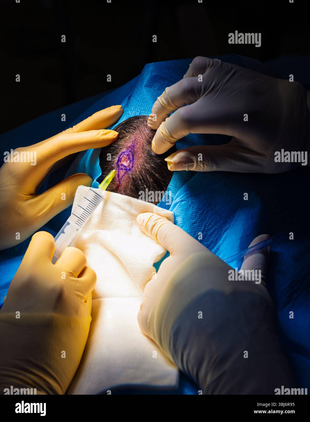 chirurgie dermatologique en salle d'opération. Injection d'anesthésie dans les bords d'une tumeur cutanée. Carcinome épidermoïde. Les mains d'un chirurgien et les siennes Banque D'Images