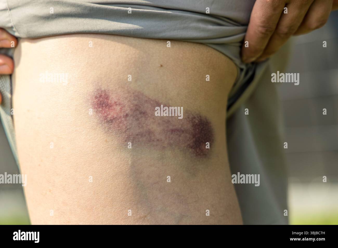 gros bleus sur la peau de jambe de l'homme en gros plan. Banque D'Images