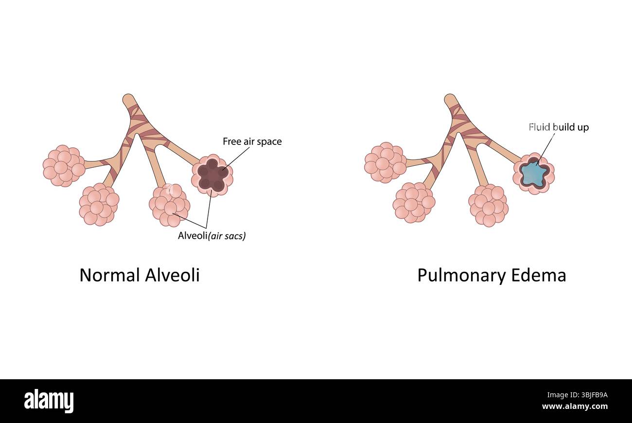 Illustration vectorielle de l'oedème pulmonaire Illustration de Vecteur