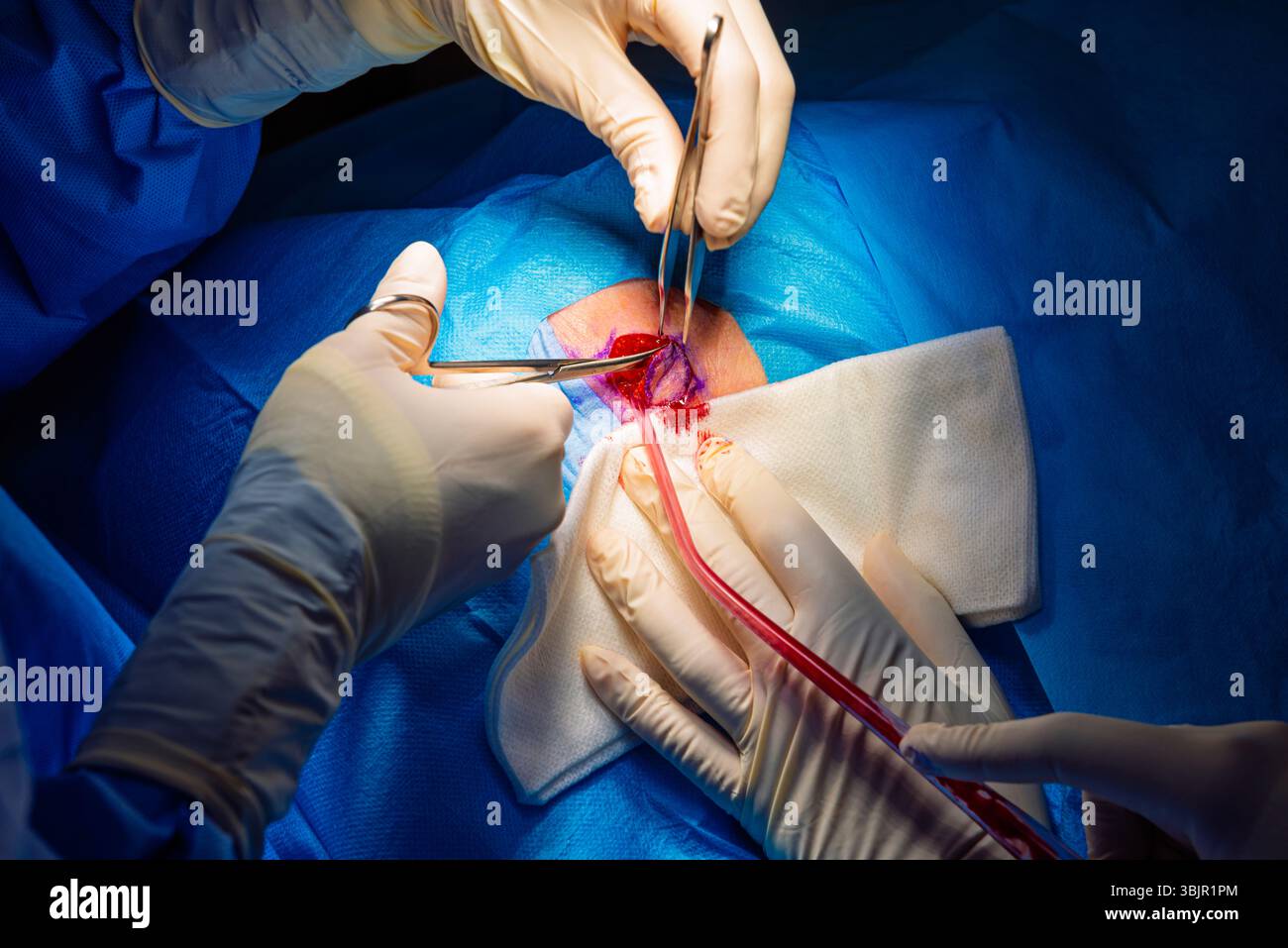 Chirurgie dermatologique au bloc opératoire. Découpe de la lésion et fluides d'aspiration.carcinome épidermoïde.les mains d'un chirurgien et de son assistan Banque D'Images
