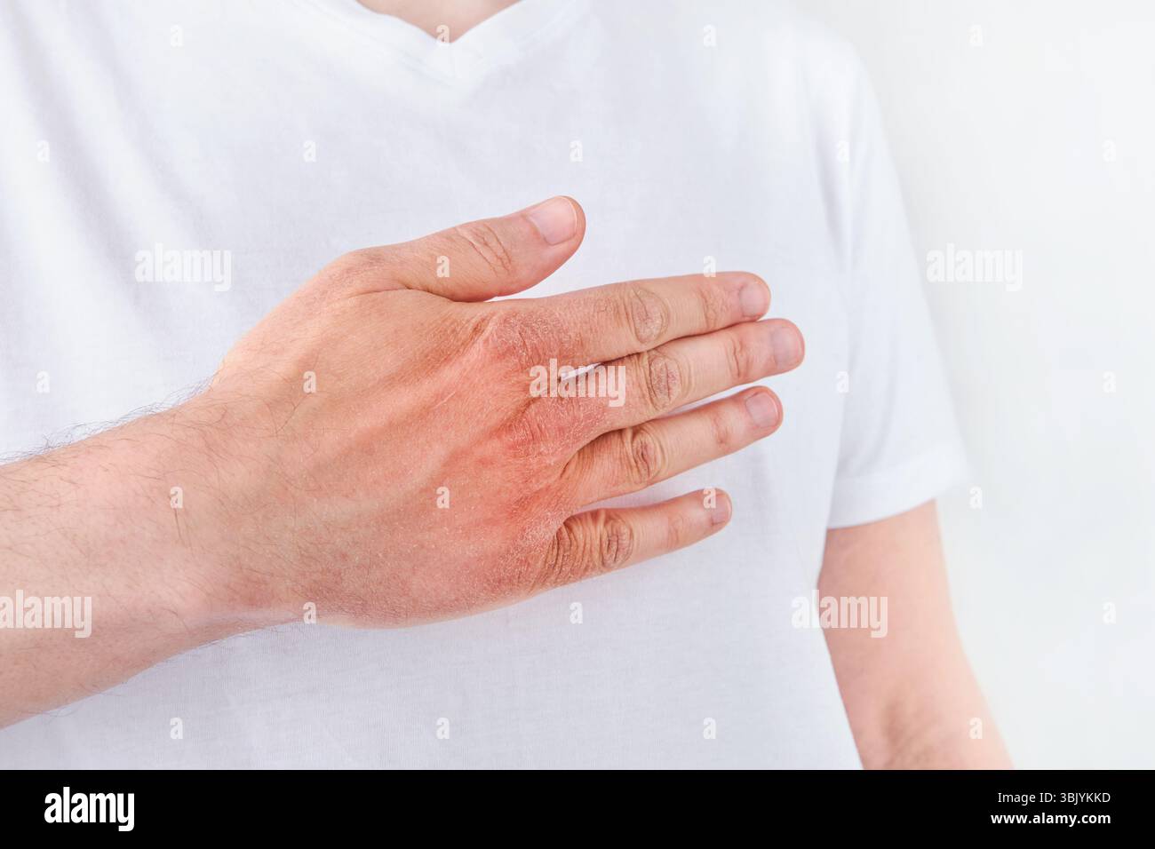 Homme gratte ou montre les mains avec la peau sèche et fissurée sur fond blanc. Problème avec beaucoup de gens - eczéma sous la main, allergies o Banque D'Images Homme gratte ou montre les mains avec la peau sèche et fissurée sur fond blanc. Problème avec beaucoup de gens - eczéma sous la main, allergies o Banque D'Images