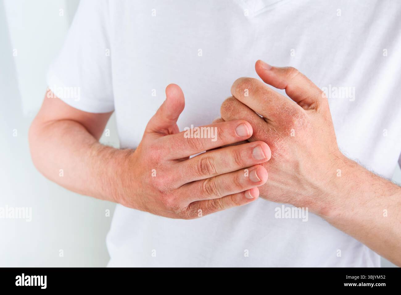 Homme gratte ou montre les mains avec la peau sèche et fissurée sur fond blanc. Problème avec beaucoup de gens - eczéma sous la main, allergies o Banque D'Images Homme gratte ou montre les mains avec la peau sèche et fissurée sur fond blanc. Problème avec beaucoup de gens - eczéma sous la main, allergies o Banque D'Images