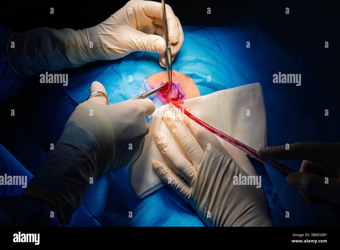 Chirurgie dermatologique au bloc opératoire. Découpe de la lésion et fluides d'aspiration.carcinome épidermoïde.les mains d'un chirurgien et de son assistan Banque D'Images