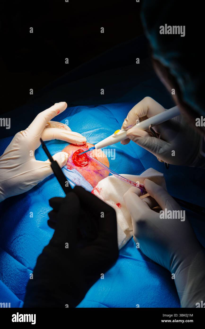 Chirurgie dermatologique au bloc opératoire. Coagulation de la lésion et aspiration de liquide. Carcinome épidermoïde. Les mains d'un chirurgien et de son assistance Banque D'Images