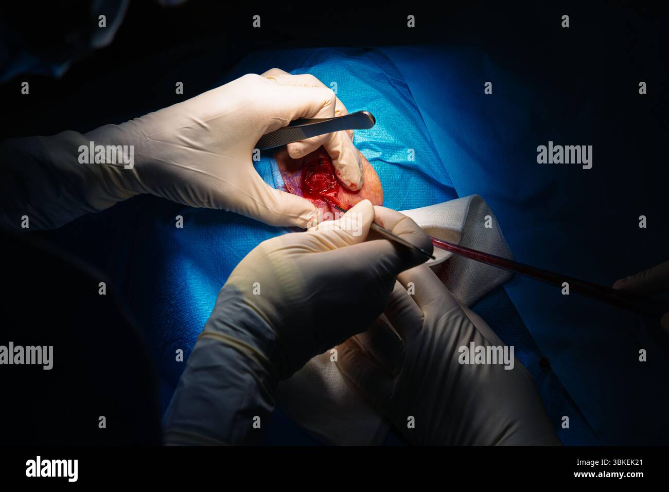 Chirurgie dermatologique au bloc opératoire. Couper autour de la lésion pour enlever la peau.carcinome épidermoïde.les mains d'un chirurgien et de son assistant intervenant Banque D'Images