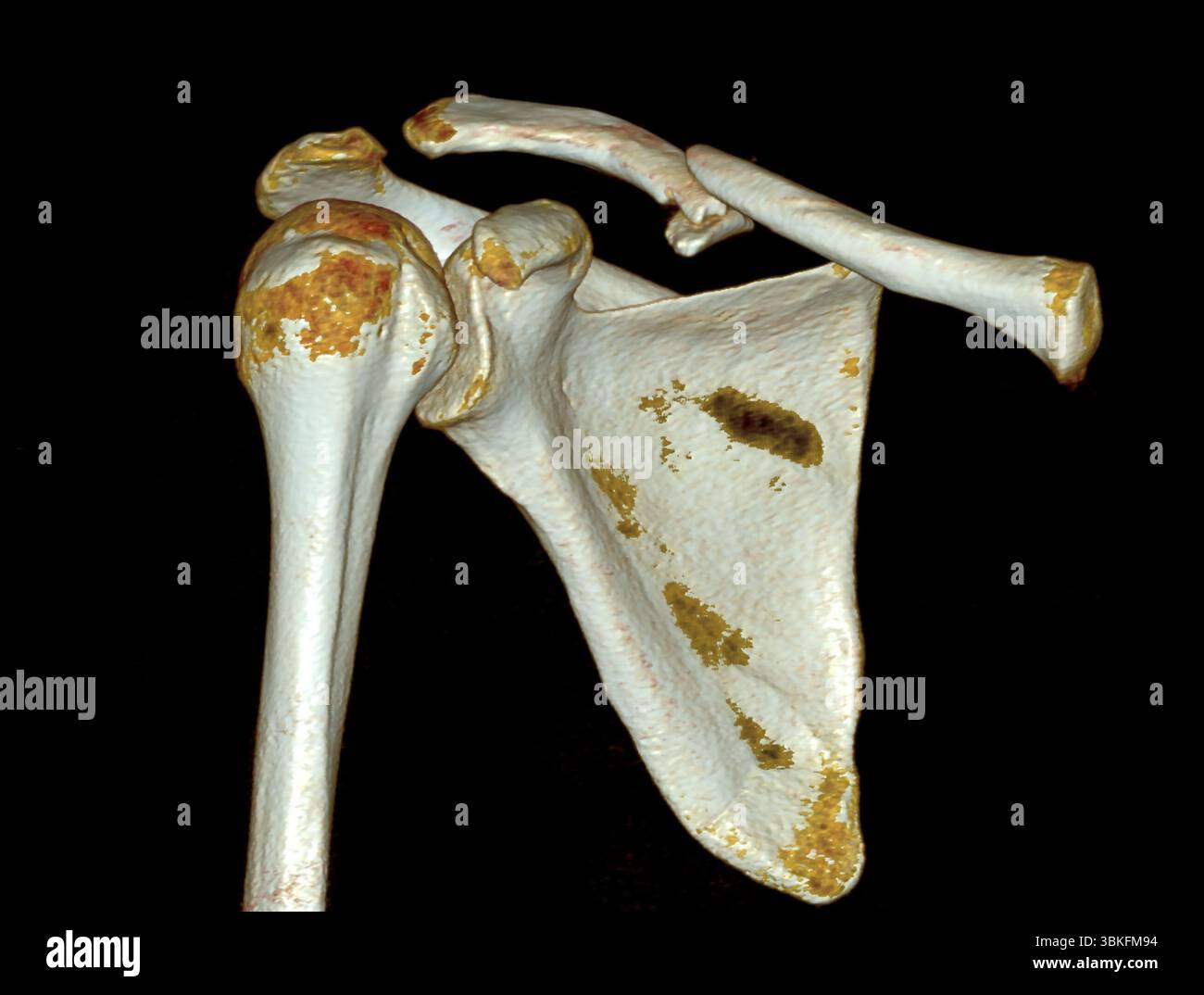 Tomodensitométrie (TDM) 3D couleur d'une articulation de l'épaule montrant une fracture de la clavicule (clavicule). Banque D'Images