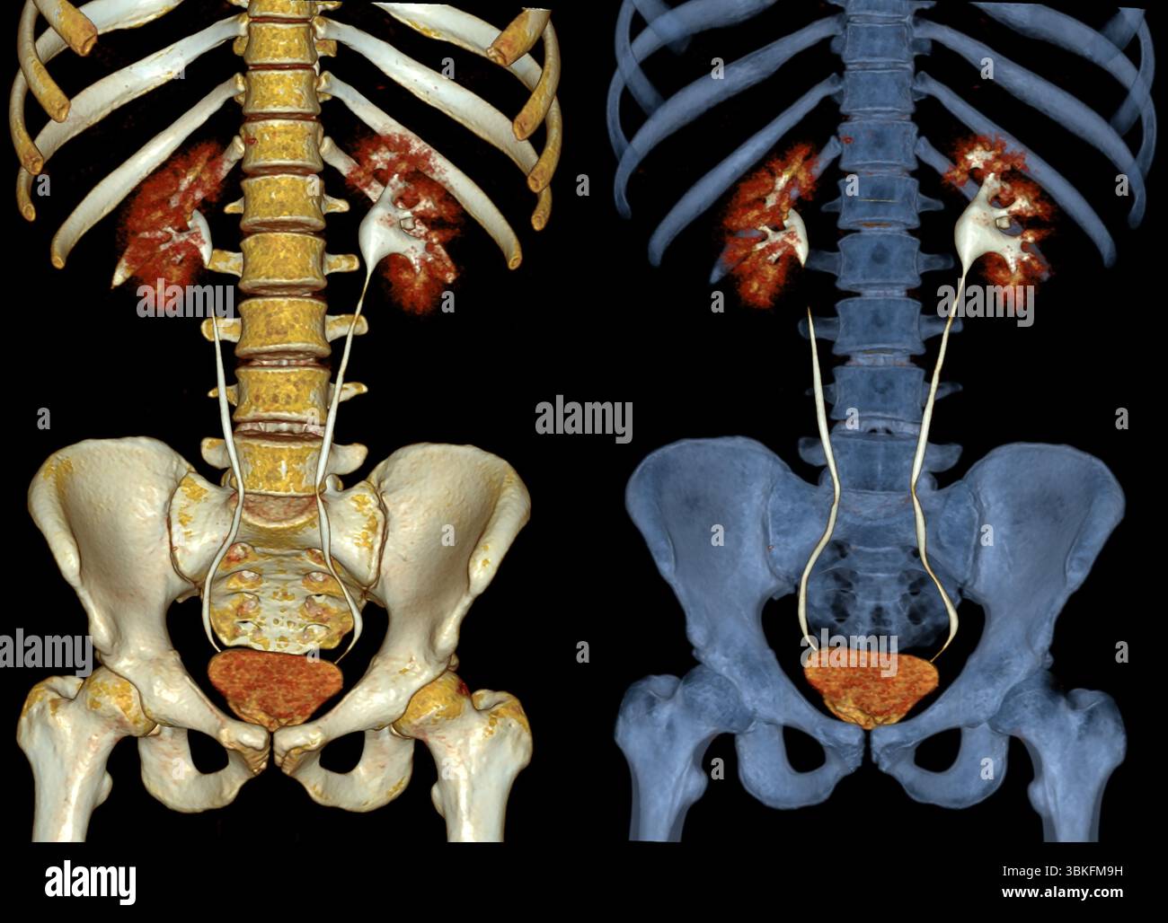 Tomodensitométrie (TDM) 3D colorée d'un rein gauche avec dilatation pelvienne marquée. Banque D'Images