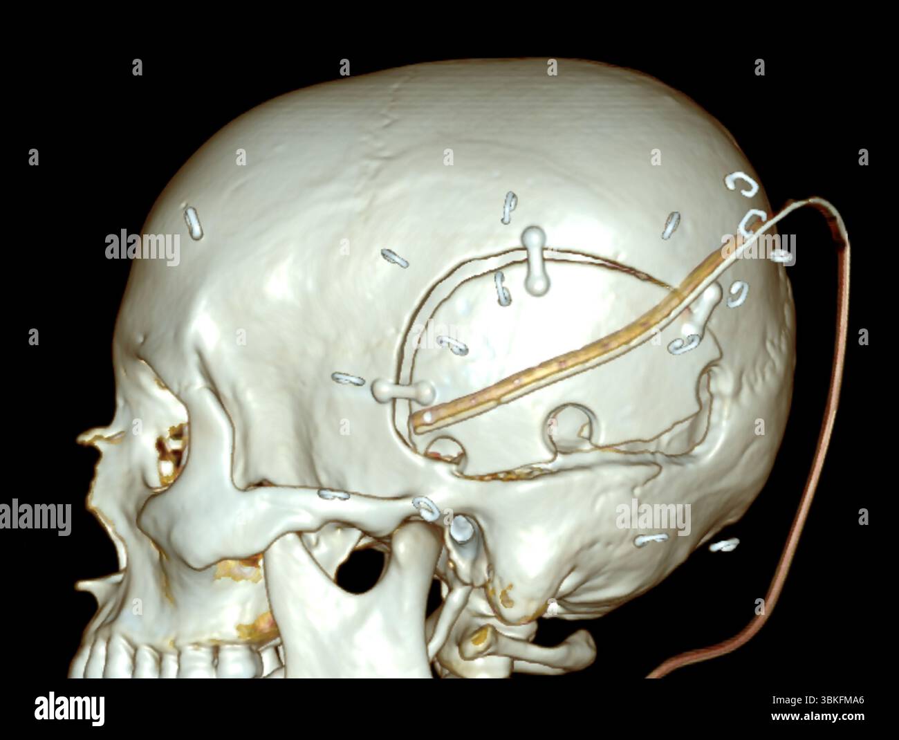 Tomodensitométrie (CT) colorée du crâne après chirurgie cérébrale. Banque D'Images