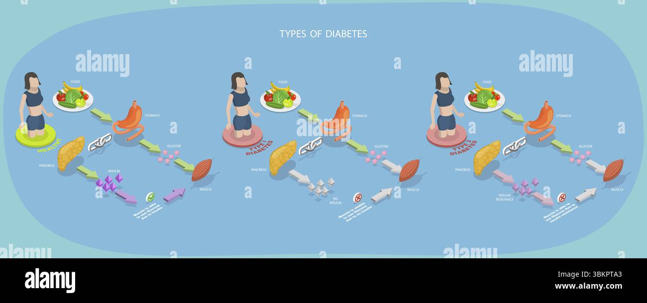 Illustration plate isométrique 3D des types de diabète, schéma médical Banque D'Images