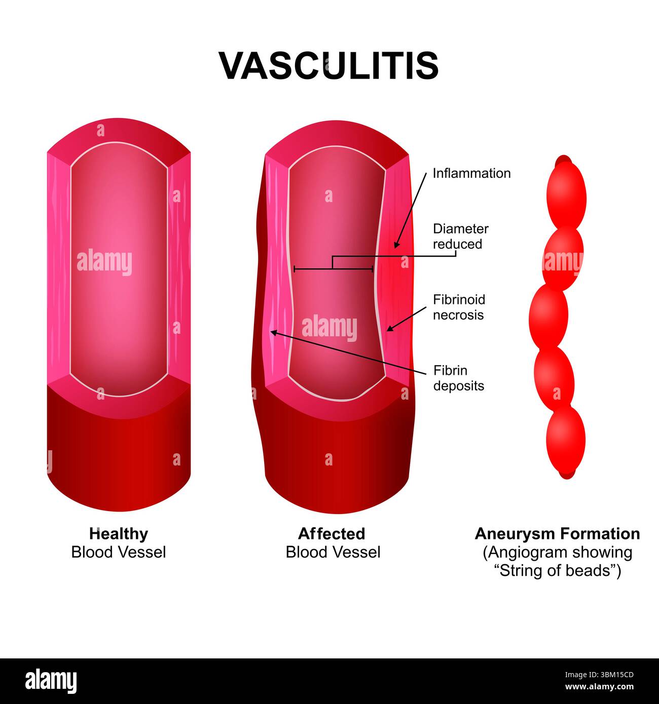 Vascularites Banque D'Images Vascularites Banque D'Images