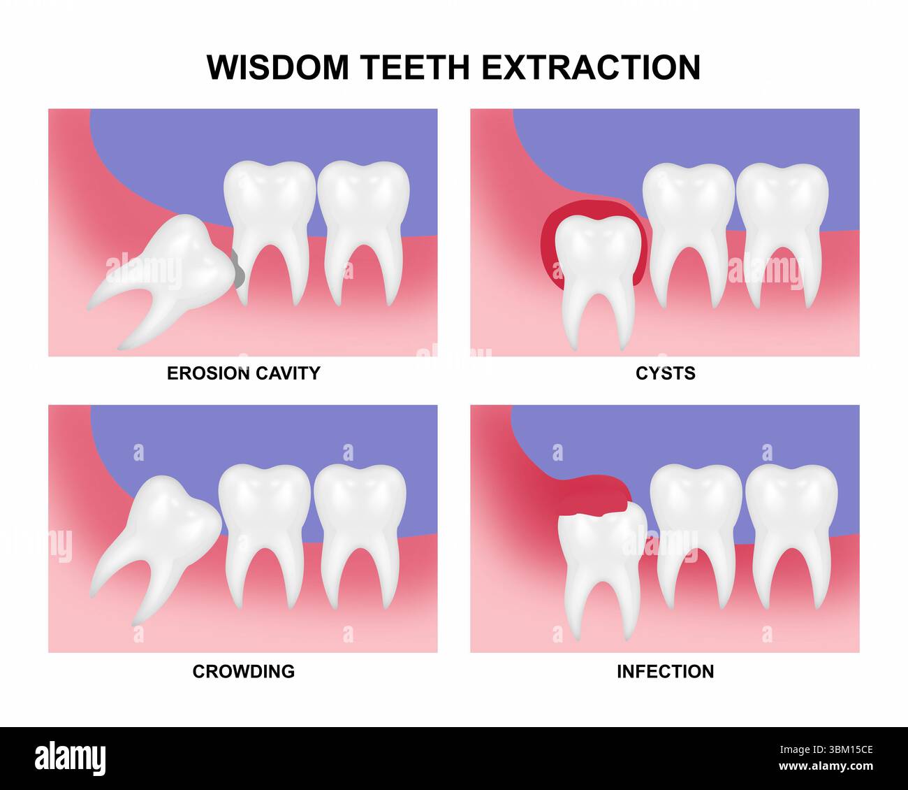 Extraction de dents de sagesse Banque D'Images