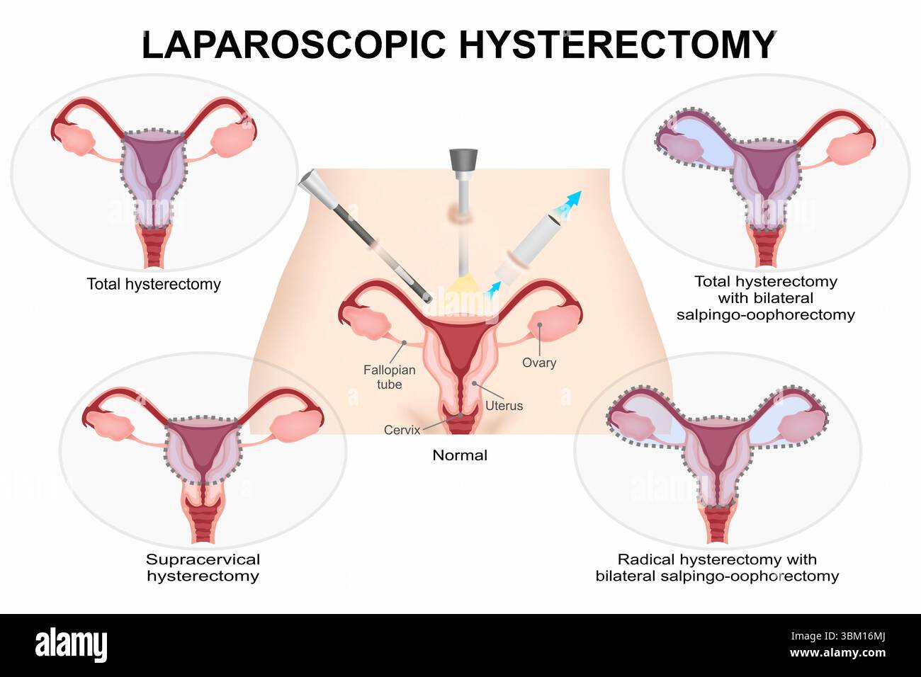 Hystérectomie coelioscopique Banque D'Images