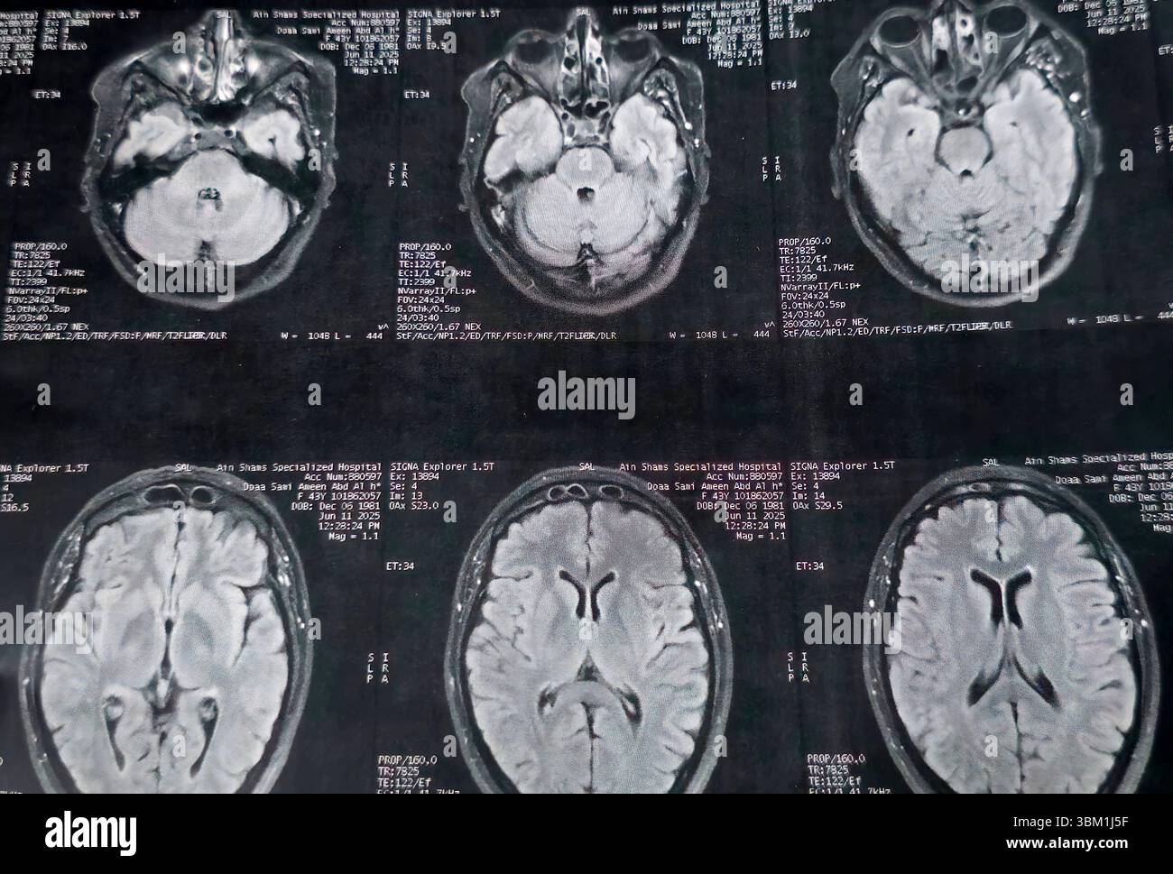 Le Caire, Égypte, 17 juin 2025 : IRM MRA Brain montre peu de petits foyers discrets de substance blanche bilatérale dispersés de signal altéré vu apprécier si lumineux Banque D'Images