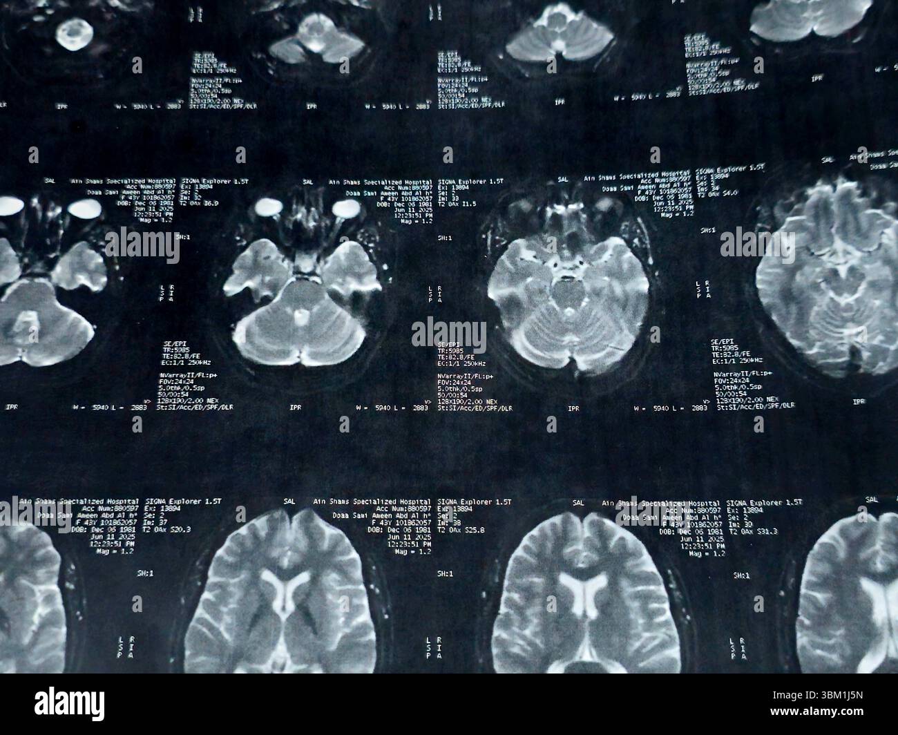 Le Caire, Égypte, 17 juin 2025 : IRM MRA Brain montre peu de petits foyers discrets de substance blanche bilatérale dispersés de signal altéré vu apprécier si lumineux Banque D'Images