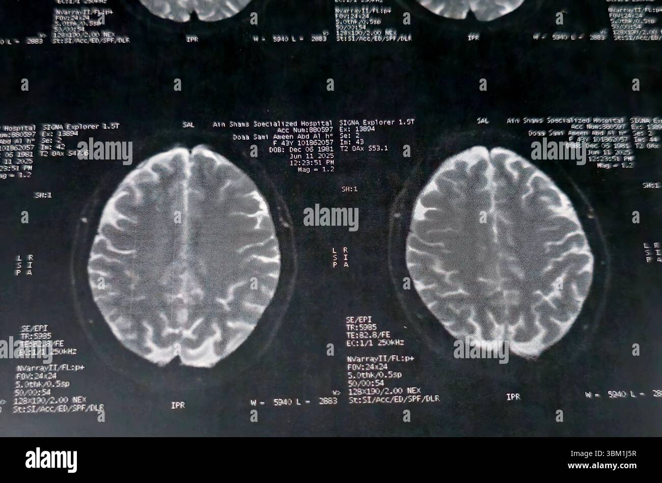 Le Caire, Égypte, 17 juin 2025 : IRM MRA Brain montre peu de petits foyers discrets de substance blanche bilatérale dispersés de signal altéré vu apprécier si lumineux Banque D'Images