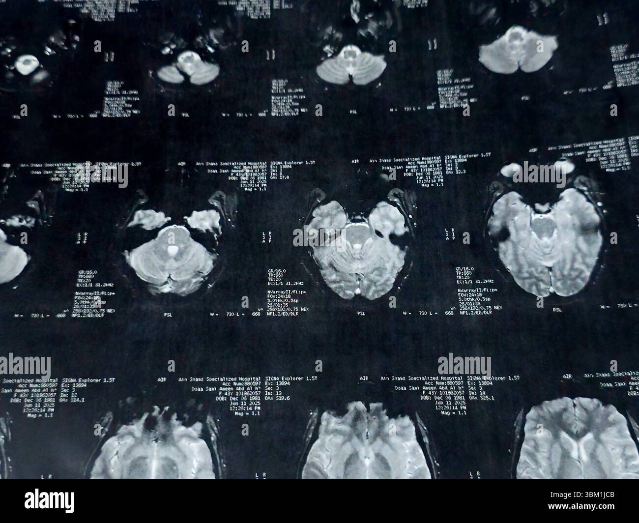 Le Caire, Égypte, 17 juin 2025 : IRM MRA Brain montre peu de petits foyers discrets de substance blanche bilatérale dispersés de signal altéré vu apprécier si lumineux Banque D'Images