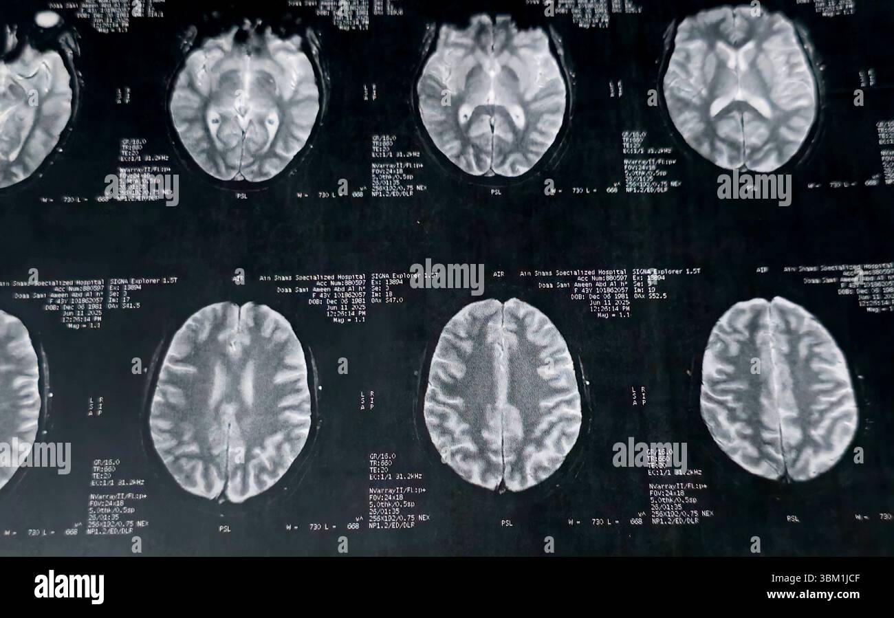 Le Caire, Égypte, 17 juin 2025 : IRM MRA Brain montre peu de petits foyers discrets de substance blanche bilatérale dispersés de signal altéré vu apprécier si lumineux Banque D'Images