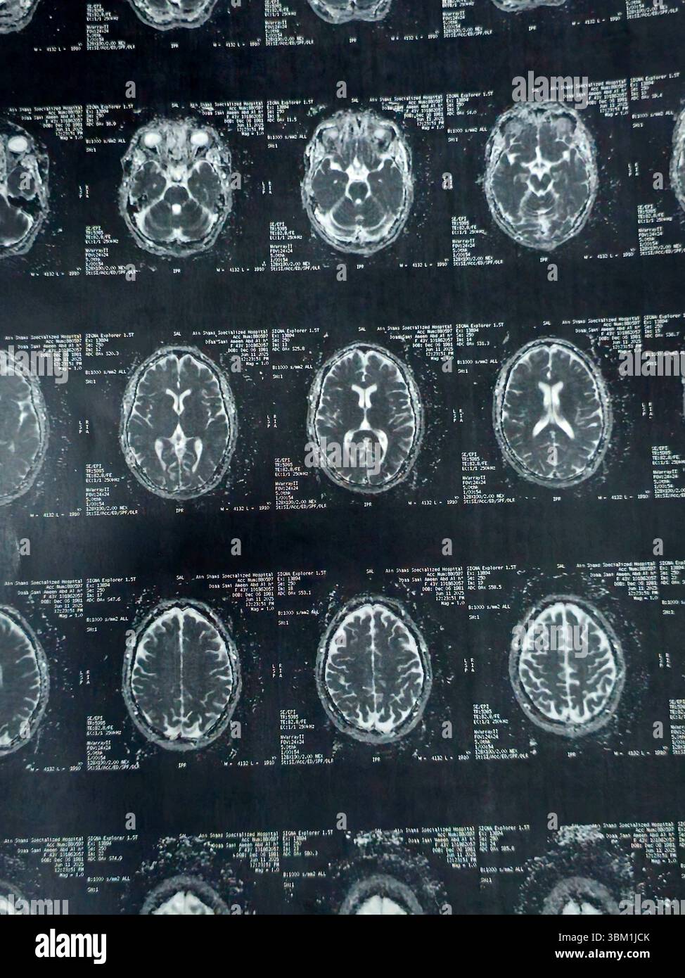 Le Caire, Égypte, 17 juin 2025 : IRM MRA Brain montre peu de petits foyers discrets de substance blanche bilatérale dispersés de signal altéré vu apprécier si lumineux Banque D'Images