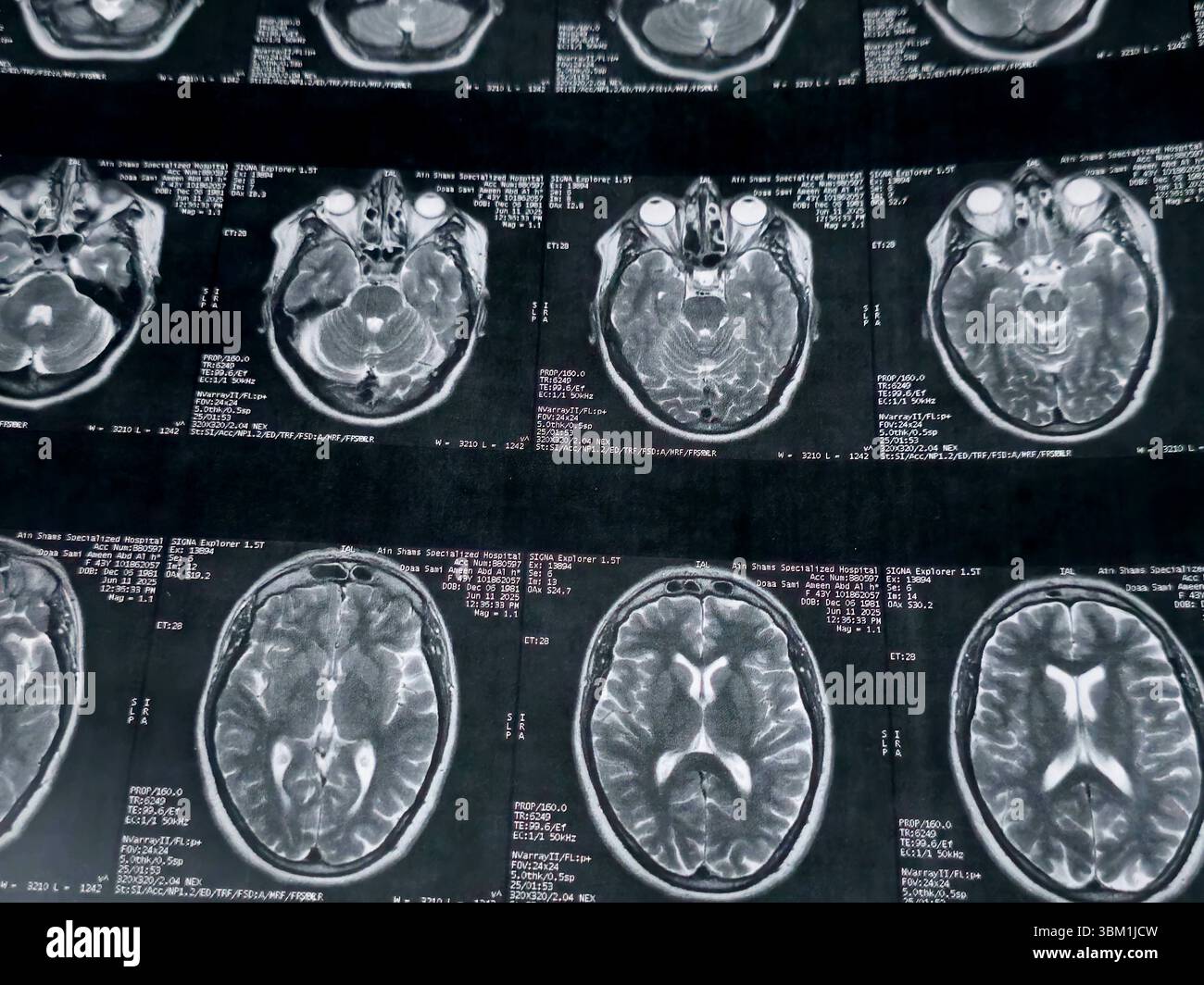 Le Caire, Égypte, 17 juin 2025 : IRM MRA Brain montre peu de petits foyers discrets de substance blanche bilatérale dispersés de signal altéré vu apprécier si lumineux Banque D'Images